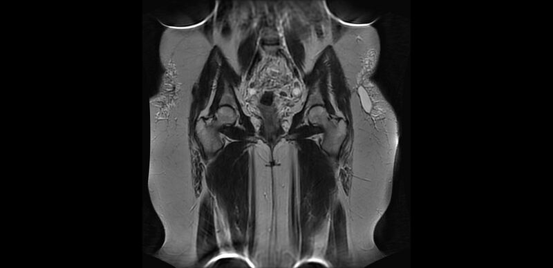 File:Buttock filler complications (Radiopaedia 63497-72115 Coronal T2 9).jpg