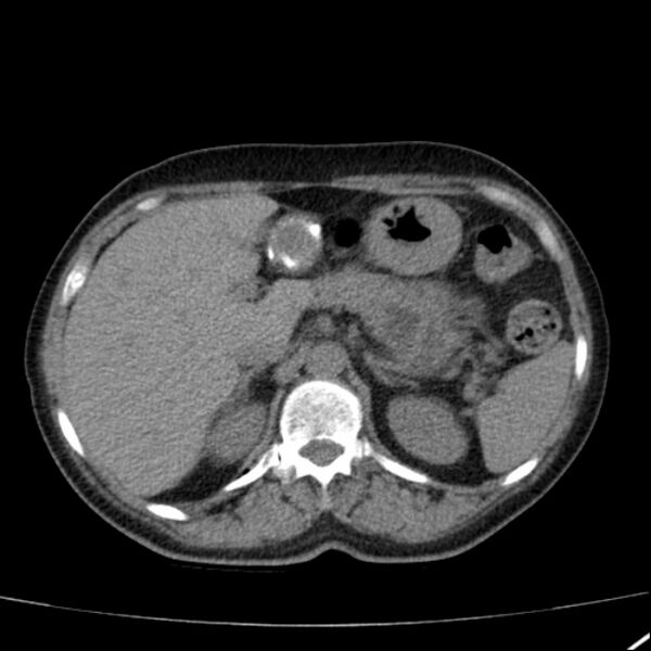 File:Calcified hepatic hydatid cyst (Radiopaedia 26872-27046 Axial non-contrast 25).jpg