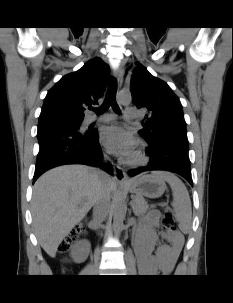 File:Calcifying pulmonary metastases (Radiopaedia 33359-34396 Coronal non-contrast 24).jpg