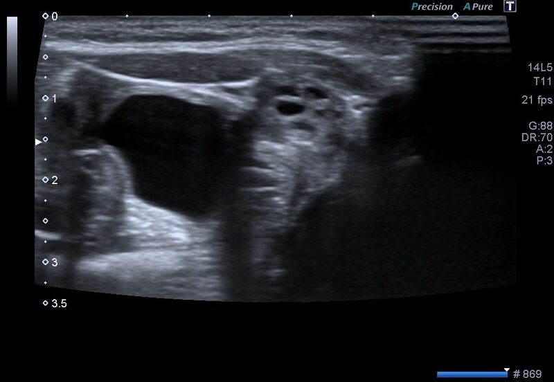 File:Canal of Nuck hernia - bilateral ovaries (Radiopaedia 57930-64900 D 1).jpg