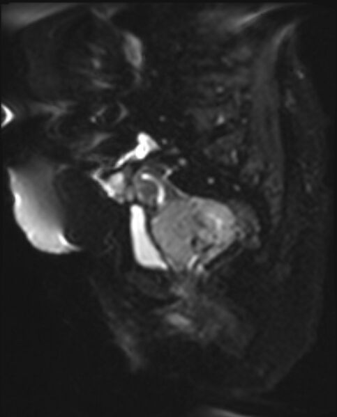 File:Cancer cervix - stage IIb (Radiopaedia 75411-86615 Sagittal DWI 9).jpg