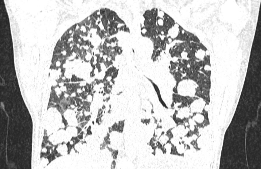 Cannonball metastases from breast cancer (Radiopaedia 91024-108569 Coronal lung window 89).jpg