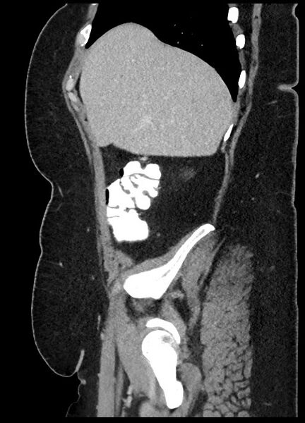 File:Carcinoid tumor - terminal ileum (Radiopaedia 60931-68739 C 84).jpg