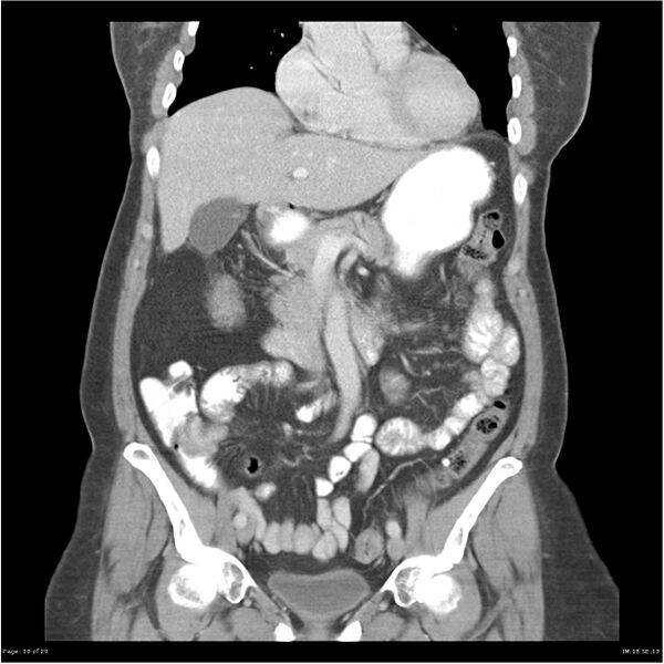 File:Carcinoid tumor of the ileum with metastasis to orbit (Radiopaedia 28165-28425 B 10).jpg
