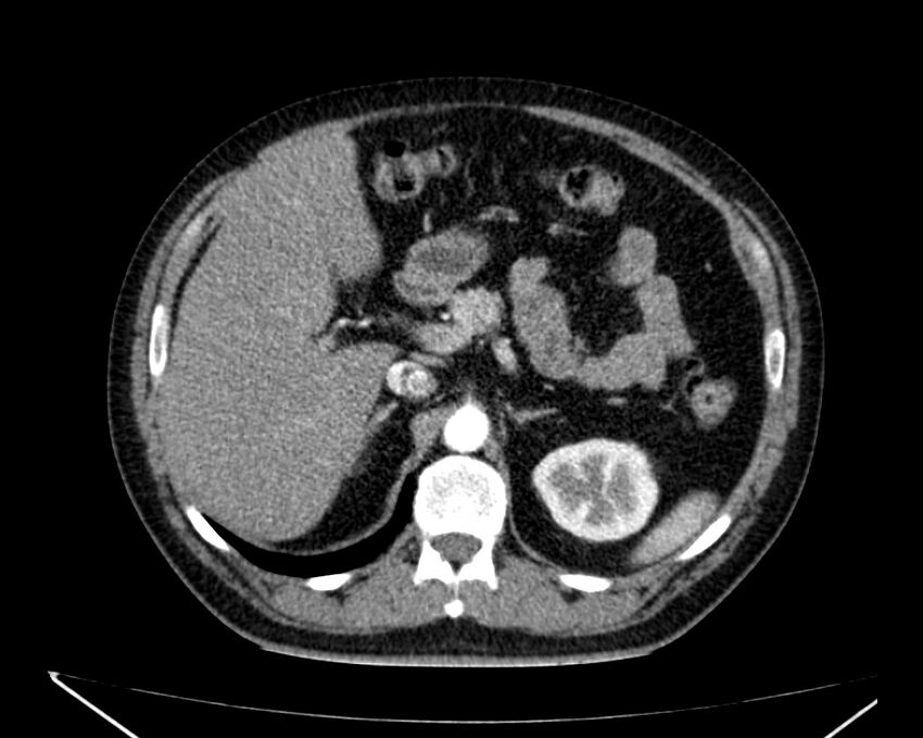 Carcinoid tumor with hepatic metastases (Radiopaedia 22651-22670 B 27).jpg