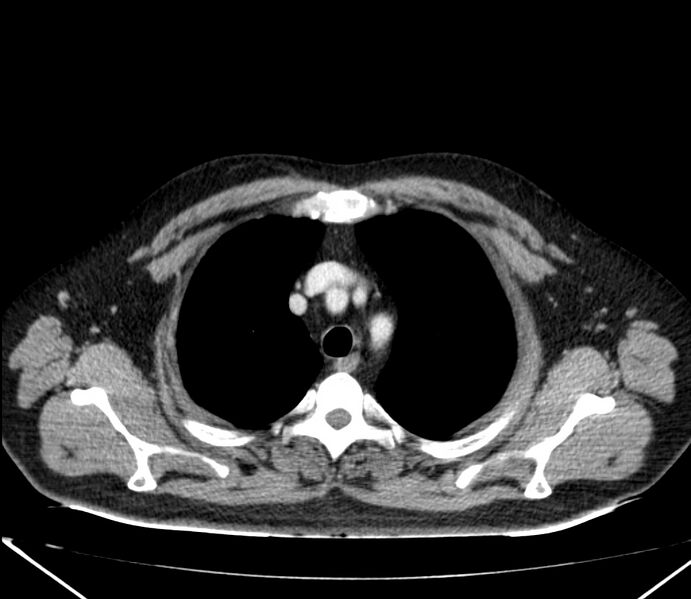 File:Carcinoid tumor with hepatic metastases (Radiopaedia 22651-22670 C 7).jpg