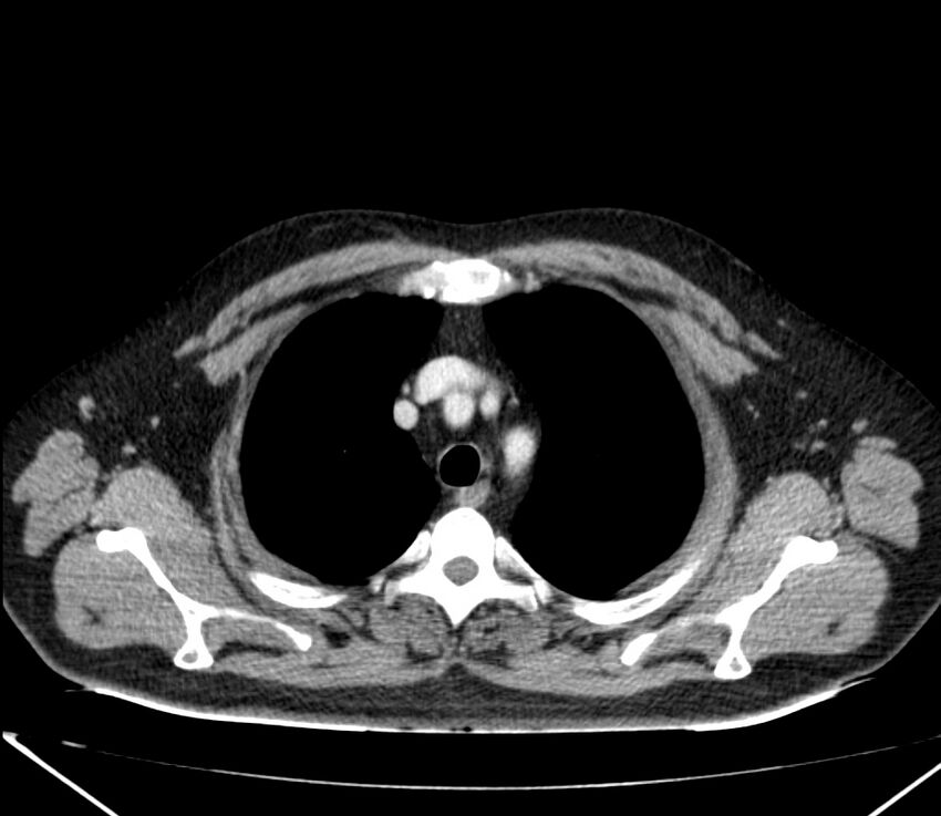 Carcinoid tumor with hepatic metastases (Radiopaedia 22651-22670 C 7).jpg