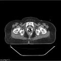 Carcinoma cervix- brachytherapy applicator (Radiopaedia 33135-34173 Axial non-contrast 41).jpg
