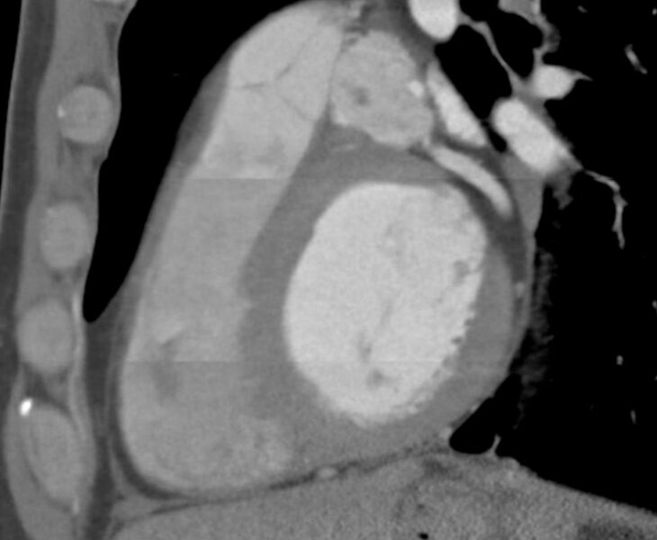 File:Cardiac hemangioma (Radiopaedia 16971-16679 C 5).JPG