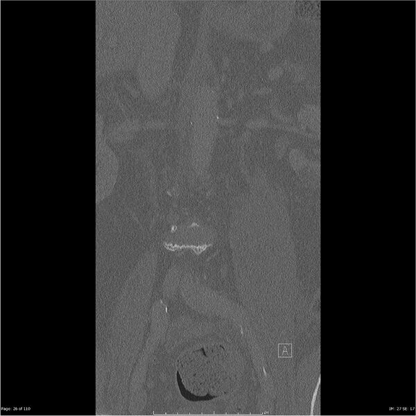 File:Cardiac trauma (Radiopaedia 32874-33858 Coronal bone window 26).jpg