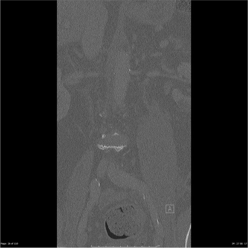 Cardiac trauma (Radiopaedia 32874-33858 Coronal bone window 26).jpg