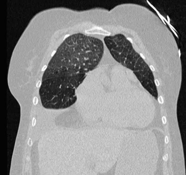 File:Cardiogenic pulmonary edema (Radiopaedia 29213-29609 Coronal lung window 17).jpg