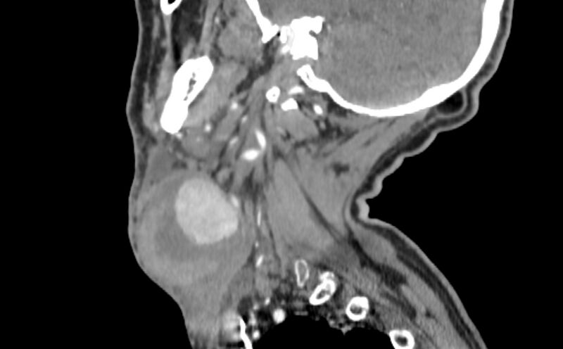 File:Carotid artery pseudoaneurysm (Radiopaedia 84030-99259 E 36).jpg
