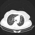 Carotid body tumor (Radiopaedia 21021-20948 Axial lung window 11).jpg
