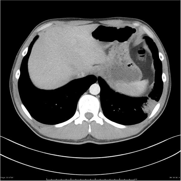 File:Cavitating lung cancer (Radiopaedia 25796-25945 C+ arterial phase 53).jpg