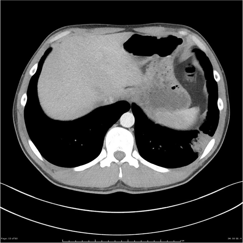 Cavitating lung cancer (Radiopaedia 25796-25945 C+ arterial phase 53).jpg