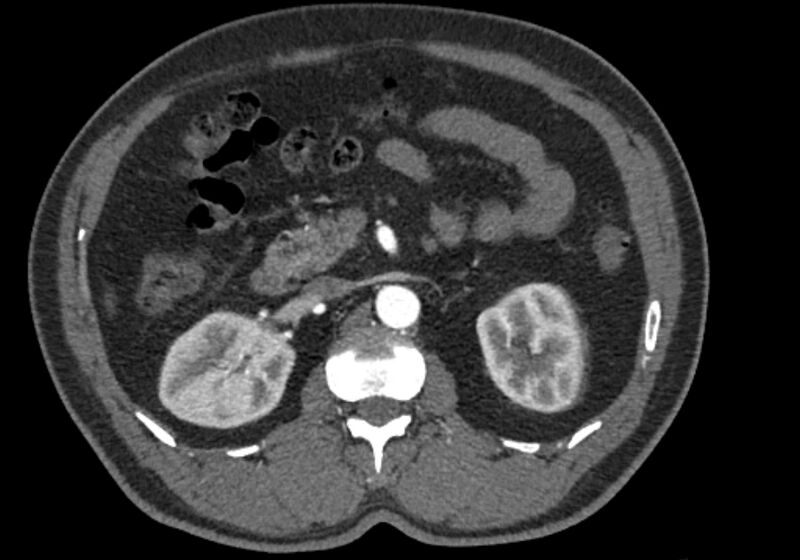 File:Celiac artery dissection (Radiopaedia 52194-58080 A 39).jpg