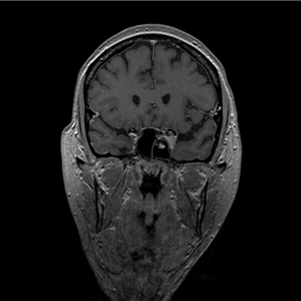 File:Central base of skull meningioma (Radiopaedia 53531-59549 Coronal T1 C+ 3).jpg