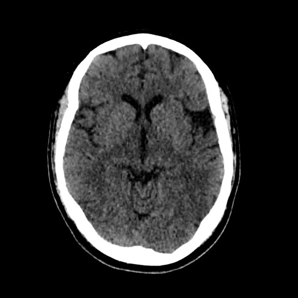 File:Central nervous system Langerhans cell histiocytosis (Radiopaedia 65728-74878 Axial non-contrast 25).jpg