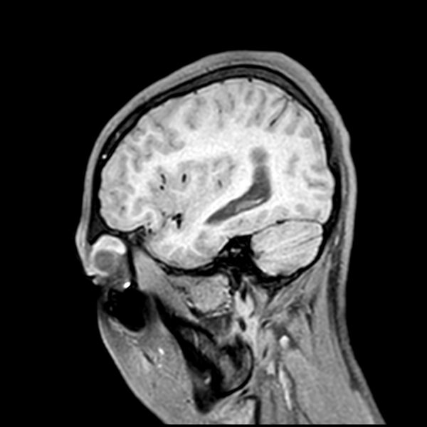 File:Central neurocytoma (Radiopaedia 79320-92380 Sagittal T1 197).jpg
