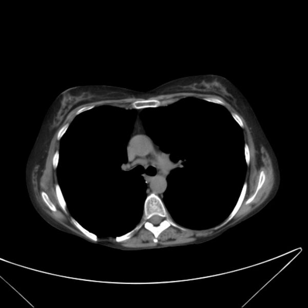File:Centrilobular pulmonary emphysema (Radiopaedia 24495-24789 Axial non-contrast 20).jpg