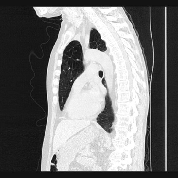 File:Centrilobular pulmonary emphysema (Radiopaedia 24495-24789 Sagittal lung window 47).jpg