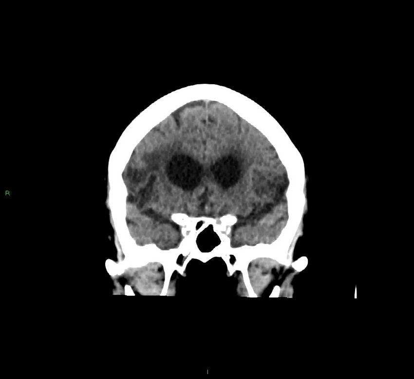 Cerebellar hemorrhage (Radiopaedia 58793-66027 Coronal non-contrast 46).jpg
