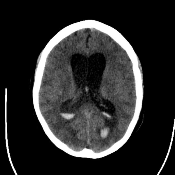 File:Cerebellar hemorrhage causing obstructive hydrocephalus (Radiopaedia 33989-35207 Axial non-contrast 29).jpg