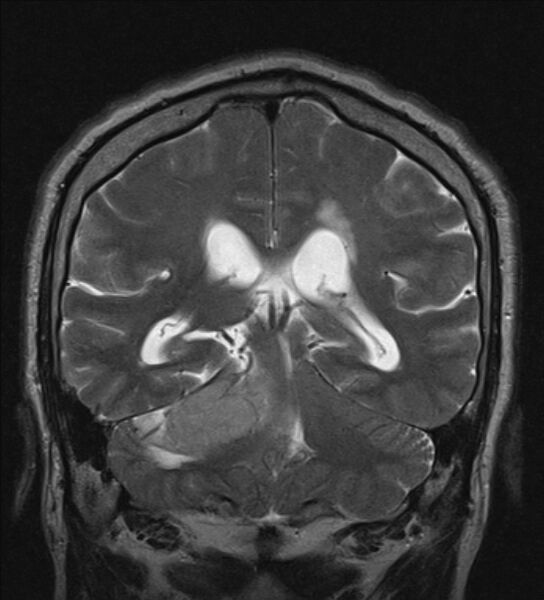 File:Cerebellopontine angle meningioma (Radiopaedia 24459-24764 Coronal T2 16).jpg