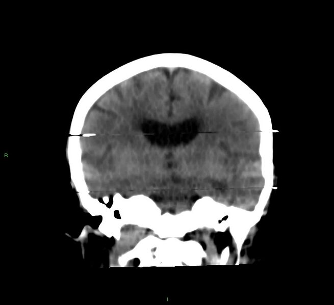 File:Cerebral amyloid angiopathy-associated lobar intracerebral hemorrhage (Radiopaedia 58377-65514 Coronal non-contrast 34).jpg