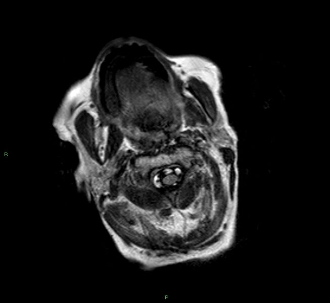 File:Cerebral amyloid angiopathy-associated lobar intracerebral hemorrhage (Radiopaedia 58377-65515 Axial FLAIR 28).jpg