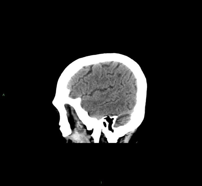 File:Cerebral amyloid angiopathy-associated lobar intracerebral hemorrhage (Radiopaedia 58529-65681 B 9).jpg