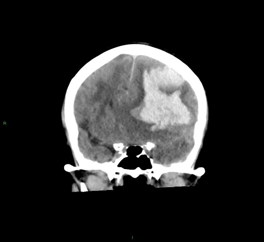 Cerebral amyloid angiopathy-associated lobar intracerebral hemorrhage (Radiopaedia 58561-65724 Coronal non-contrast 40).jpg