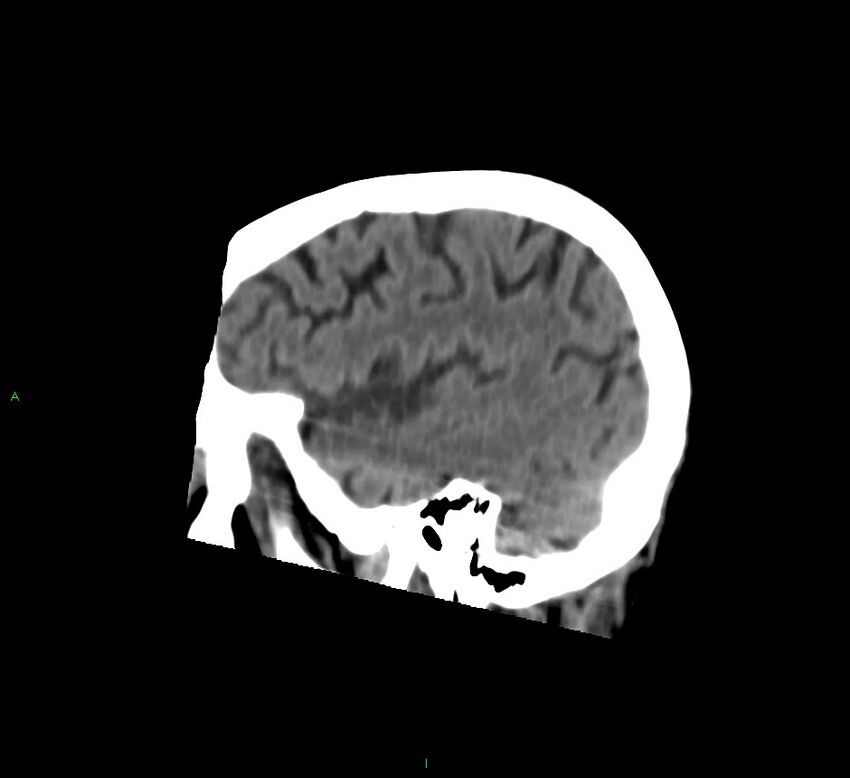 Cerebral amyloid angiopathy-associated lobar intracerebral hemorrhage (Radiopaedia 58758-65980 C 43).jpg