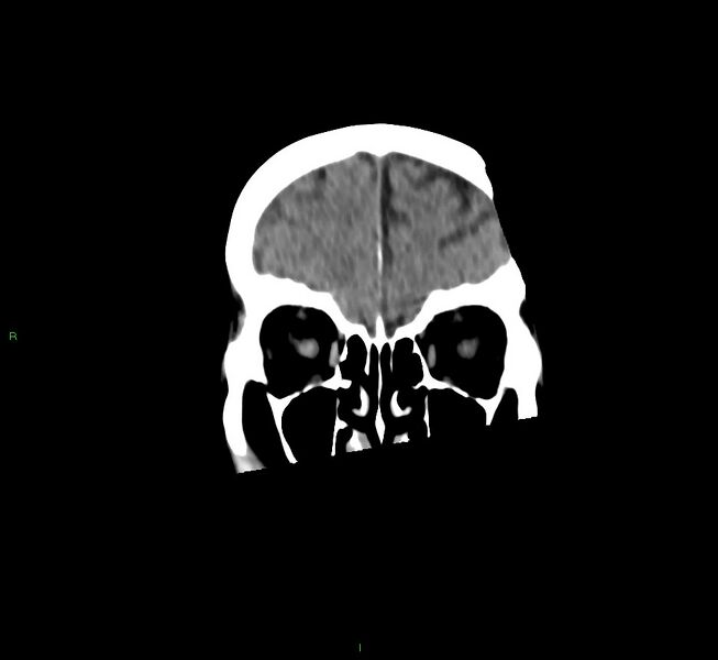 File:Cerebral amyloid angiopathy-associated lobar intracerebral hemorrhage (Radiopaedia 58758-65980 Coronal non-contrast 52).jpg