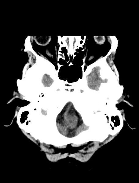 File:Cerebral aneurysm with rupture (Radiopaedia 29933-30457 Axial non-contrast 3).jpg