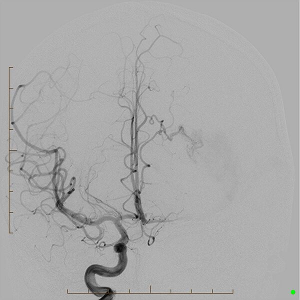 File:Cerebral arteriovenous malformation (AVM) (Radiopaedia 78162-90707 A 8).jpg