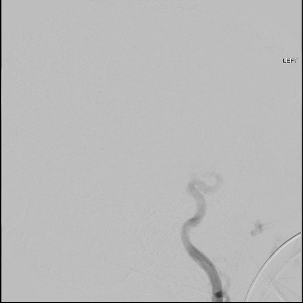 File:Cerebral arteriovenous malformation with lobar hemorrhage (Radiopaedia 44725-48513 LT CCA IC 31).png