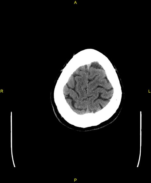 File:Cerebral autosomal dominant arteriopathy with subcortical infarcts and leukoencephalopathy (CADASIL) (Radiopaedia 86108-102051 Axial non-contrast 103).jpg