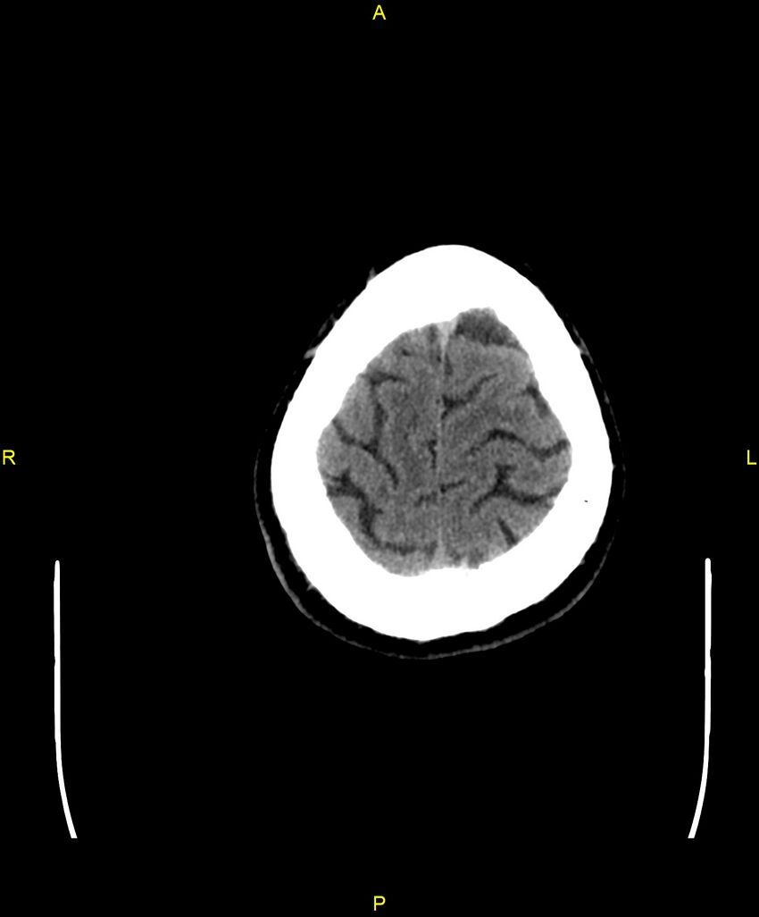 Cerebral autosomal dominant arteriopathy with subcortical infarcts and leukoencephalopathy (CADASIL) (Radiopaedia 86108-102051 Axial non-contrast 103).jpg