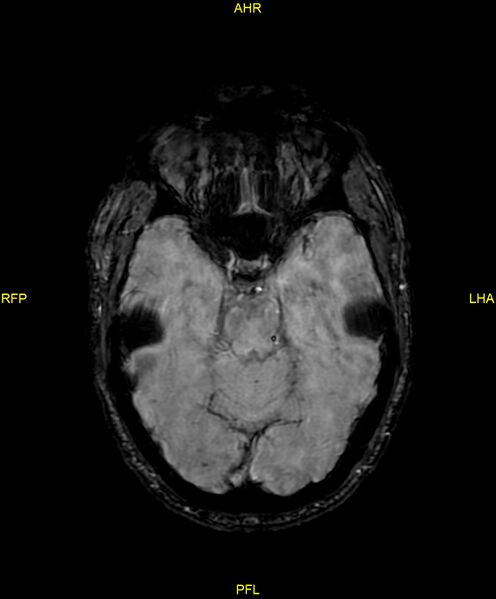File:Cerebral autosomal dominant arteriopathy with subcortical infarcts and leukoencephalopathy (CADASIL) (Radiopaedia 86108-102054 Axial SWI 41).jpg