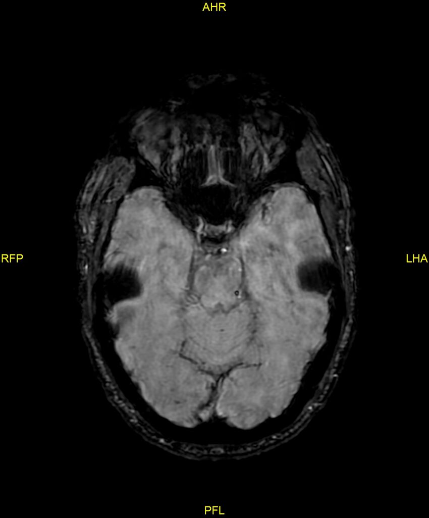 Cerebral autosomal dominant arteriopathy with subcortical infarcts and leukoencephalopathy (CADASIL) (Radiopaedia 86108-102054 Axial SWI 41).jpg