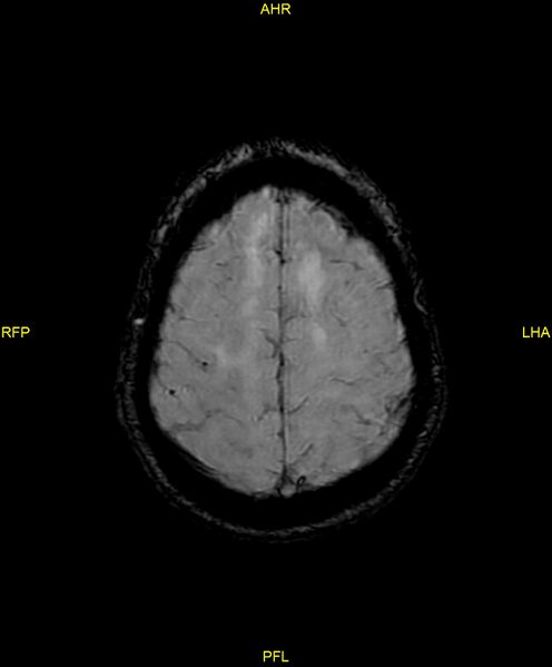 File:Cerebral autosomal dominant arteriopathy with subcortical infarcts and leukoencephalopathy (CADASIL) (Radiopaedia 86108-102054 Axial SWI 87).jpg