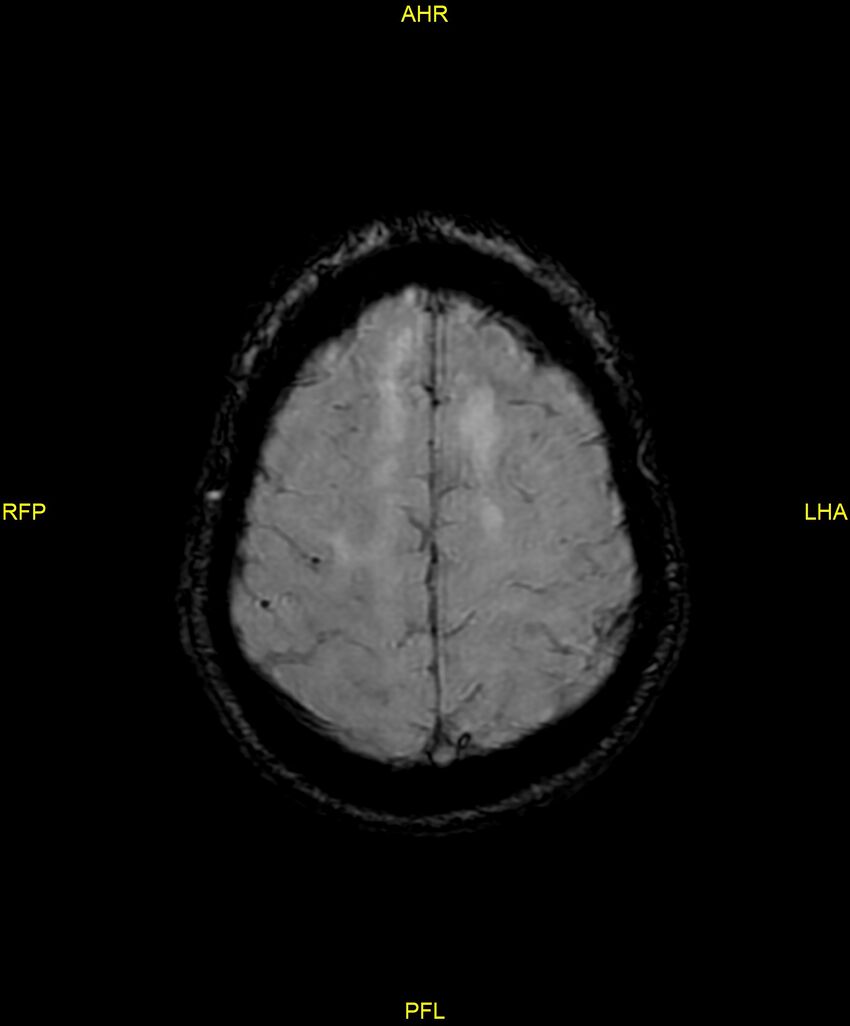 Cerebral autosomal dominant arteriopathy with subcortical infarcts and leukoencephalopathy (CADASIL) (Radiopaedia 86108-102054 Axial SWI 87).jpg
