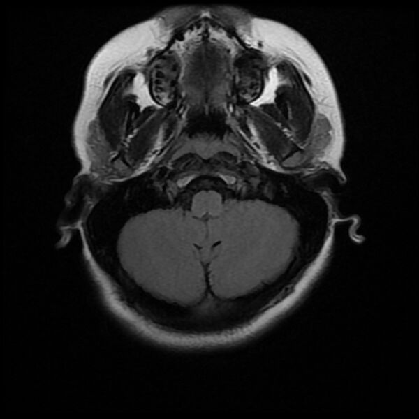 File:Cerebral cavernous malformation (Radiopaedia 44301-47942 Axial FLAIR 4).jpg