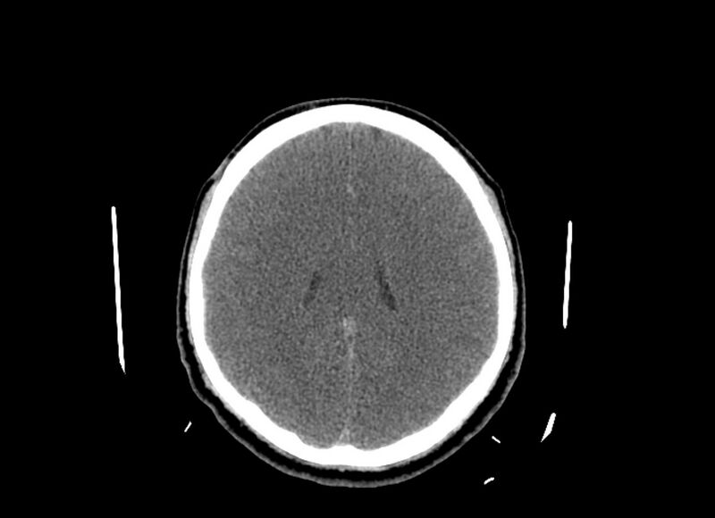 File:Cerebral edema (Radiopaedia 82519-96661 Axial non-contrast 21).jpg