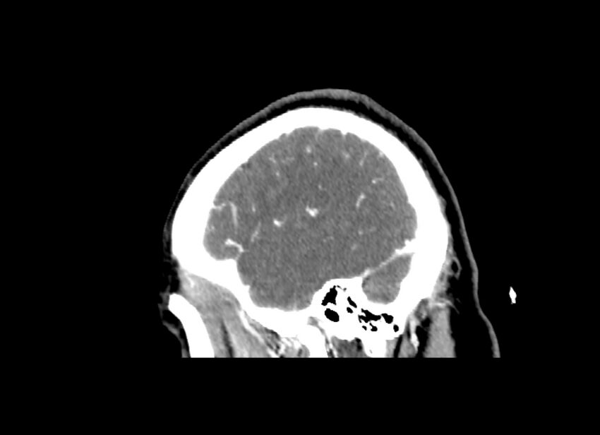 Cerebral edema (Radiopaedia 82519-96661 D 44).jpg