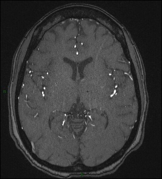 File:Cerebral fat embolism (Radiopaedia 35022-36525 Axial TOF 106).jpg