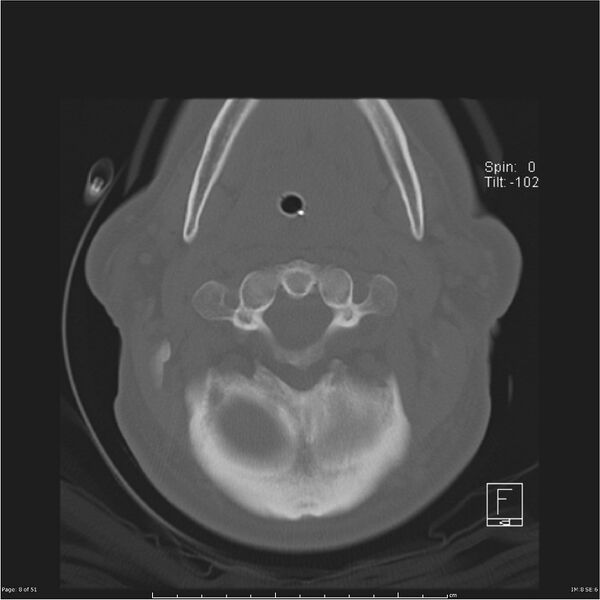 File:Cerebral hemorrhagic contusions and cervical spine fractures (Radiopaedia 32865-33841 C 8).jpg