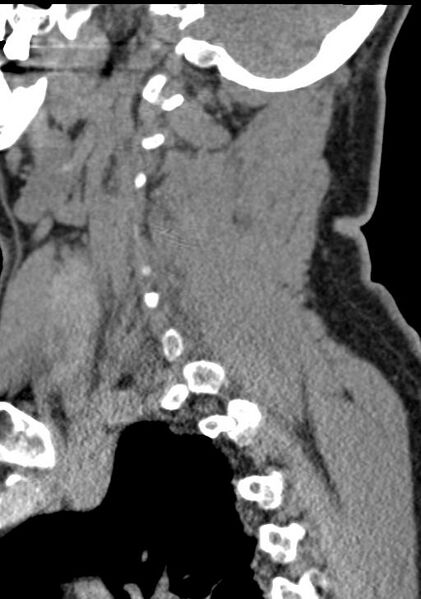 File:Cerebral hemorrhagic contusions and cervical spine fractures (Radiopaedia 32865-33841 G 80).jpg